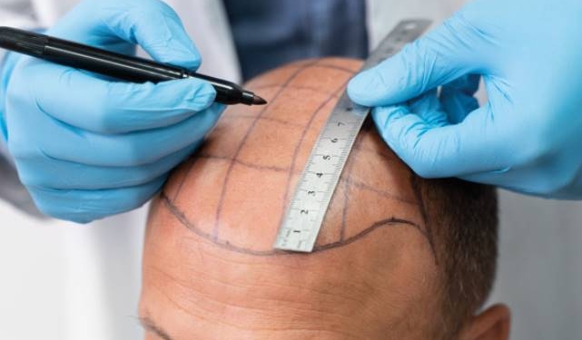 Ağrısız Saç Ekim Merkezi Esteeurope Clinic