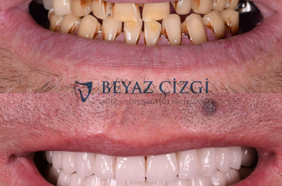 Zirkonyum Kaplama Fiyatları