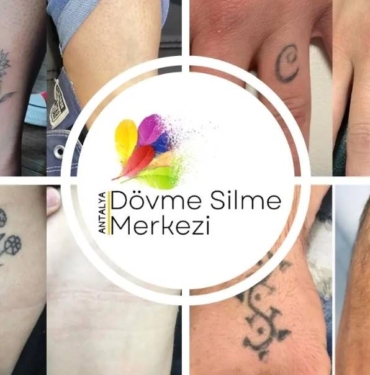 Antalya Dövme Silme Merkezi