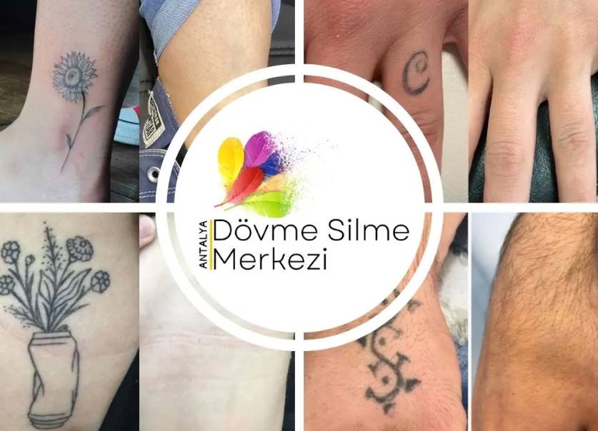 Antalya Dövme Silme Merkezi
