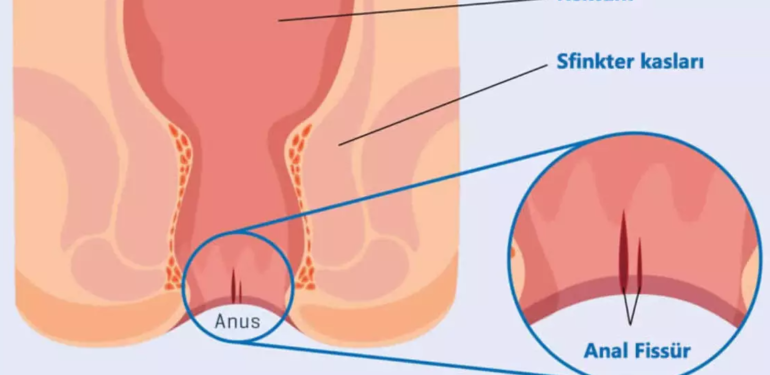 Anal Fistül nedir ve Anal Fistül Belirtileri Nelerdir?