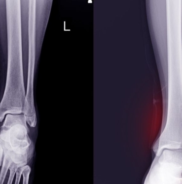 osteokondrom ameliyatı (4)