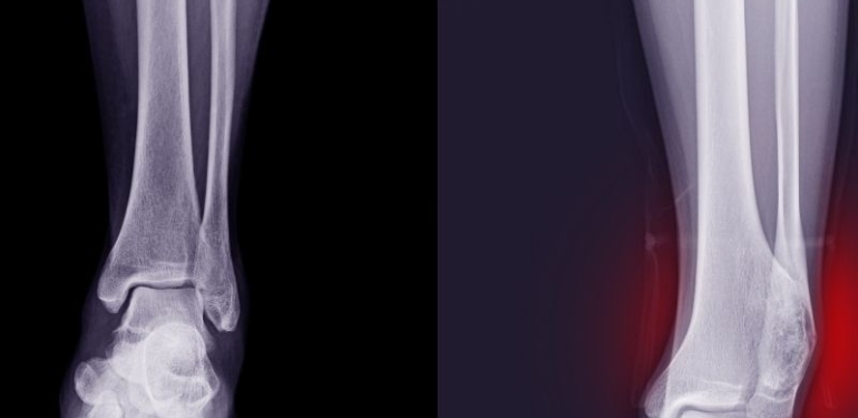 Osteokondrom ve Pudendal Sinir Sıkışması Ameliyatları