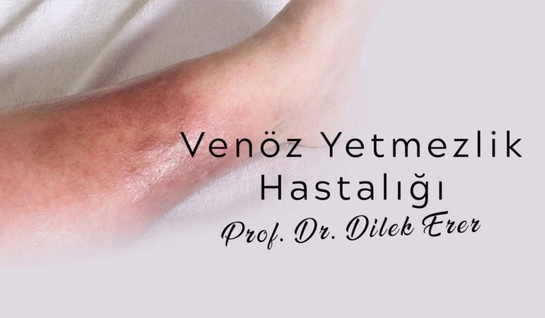 Yaşam Kalitesini Artırmak için Venöz Yetmezlik Tedavisi