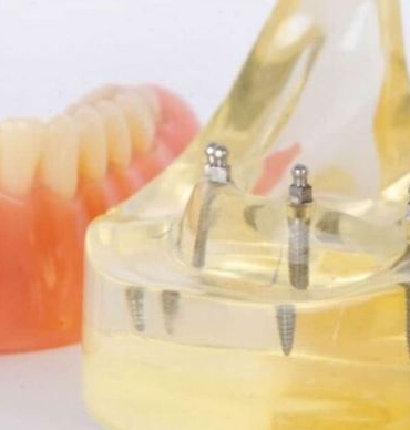 Konya implant, Konya implant fiyatları