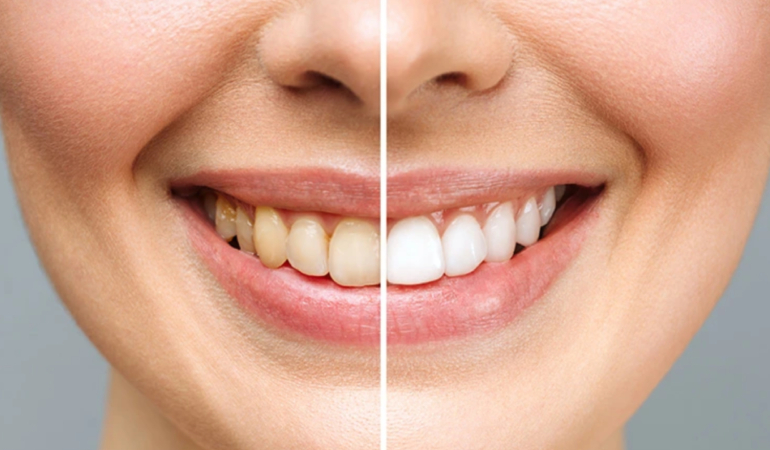 Zirkonyum Diş Kaplama Avantajları Nelerdir?