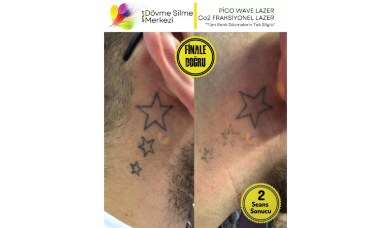 Antalya Dövme Silme Merkezi Lara Şubesinde Güvenle İzlerinizden Kurtulun